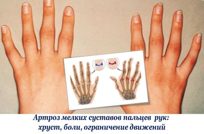 Хруст в суставах
