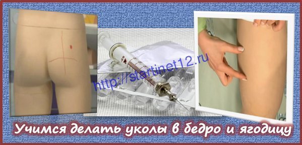 Как правильно делать укол в ягодицу в домашних условиях фото