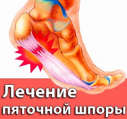 Как можно в домашних условиях вылечить пяточную шпору Как можно в домашних условиях вылечить пяточную шпору