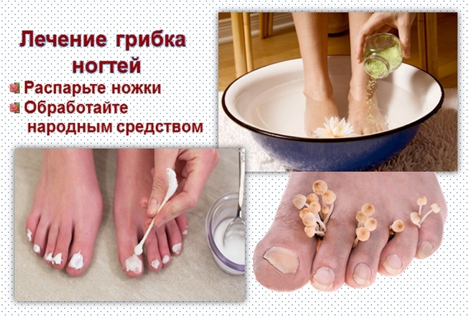 Грибок ногтей рецепт