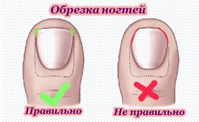 Вросший ноготь на ноге как лечить в домашних условиях Вросший ноготь на ноге как лечить в домашних условиях
