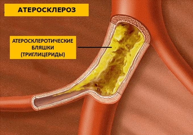 Склеротические бляшки