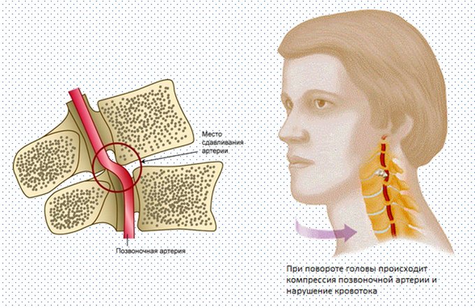 sayt spasibo golovokruzheniya osteohondroz daet sheyniy li priznatelen pomosh Дает ли шейный остеохондроз головокружения фото