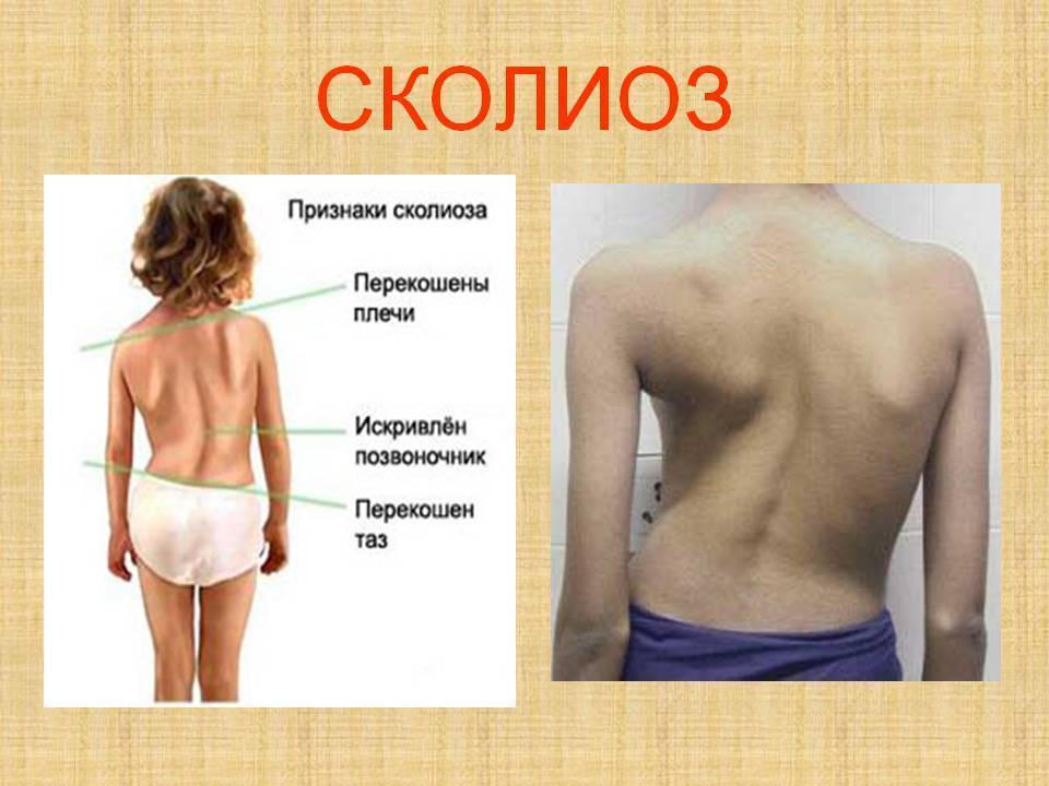 сколиоз с картинками имеет ряд уникальных